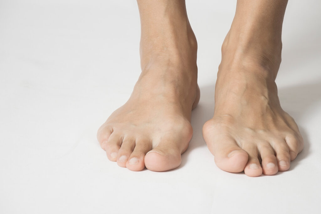 feet with Bunions