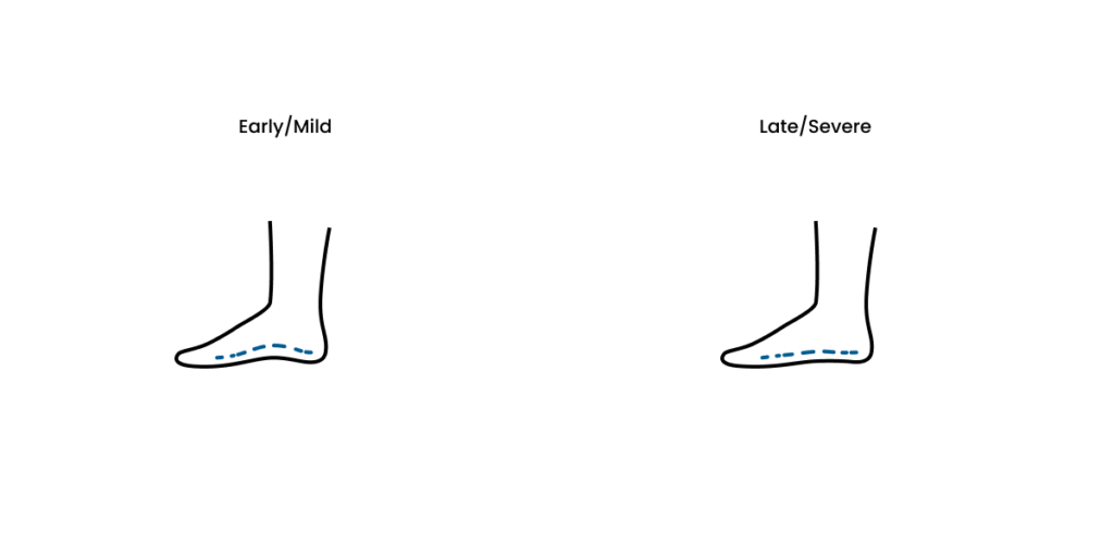 Forefoot and Arch Stability